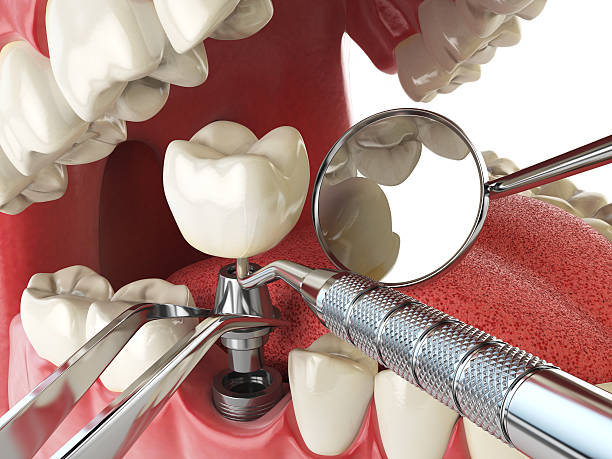Best Emergency Treatment for Dental Infections or Abscesses in Sugar City, ID